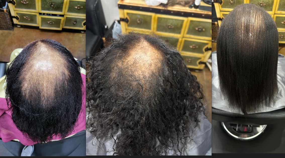 Hair Restoration Starter kit with scalp Massager